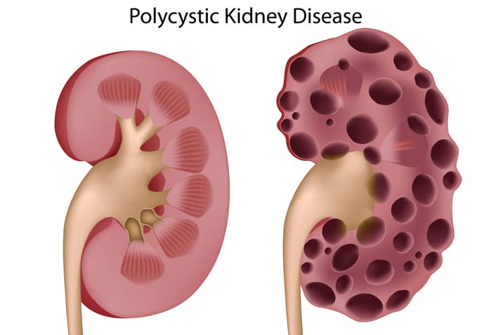 Polycystic Kidney Disease