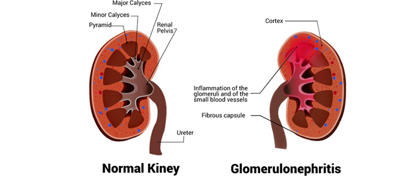 What-is-the-prognosis-for-glomerulonephritis