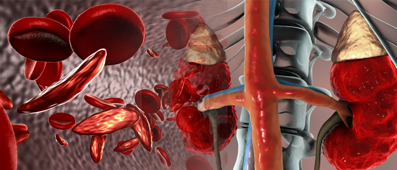 anemia-chronic-kidney-disease