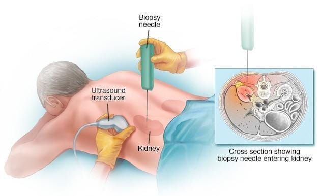 Acute Kidney Injury Treatment