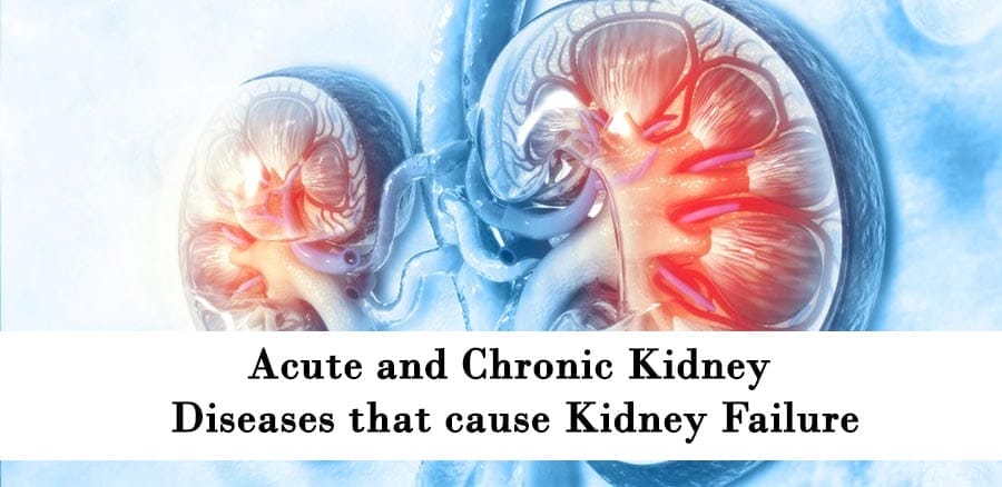 Acute-kidney-treatment