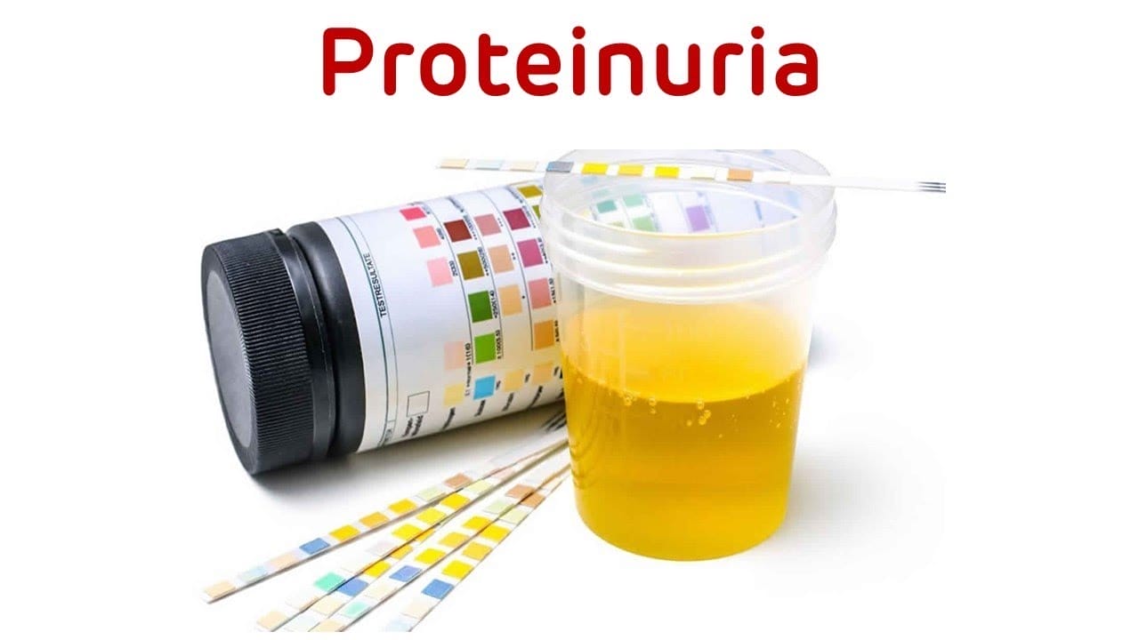 How will you know that you have Proteinuria