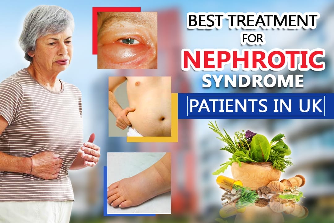 best-treatment-for-Nephrotic-Syndrome-Patients-in-UK