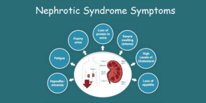 nephrotic-syndrome-symptoms