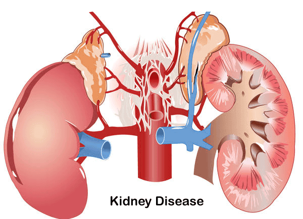 Kidney-Failure-Disease