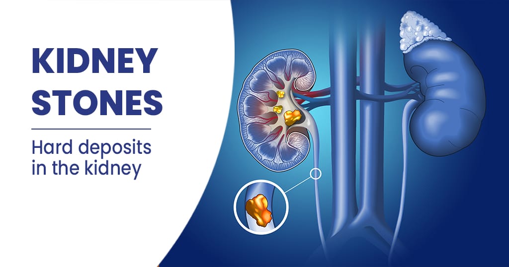 kidney-stone-treatment