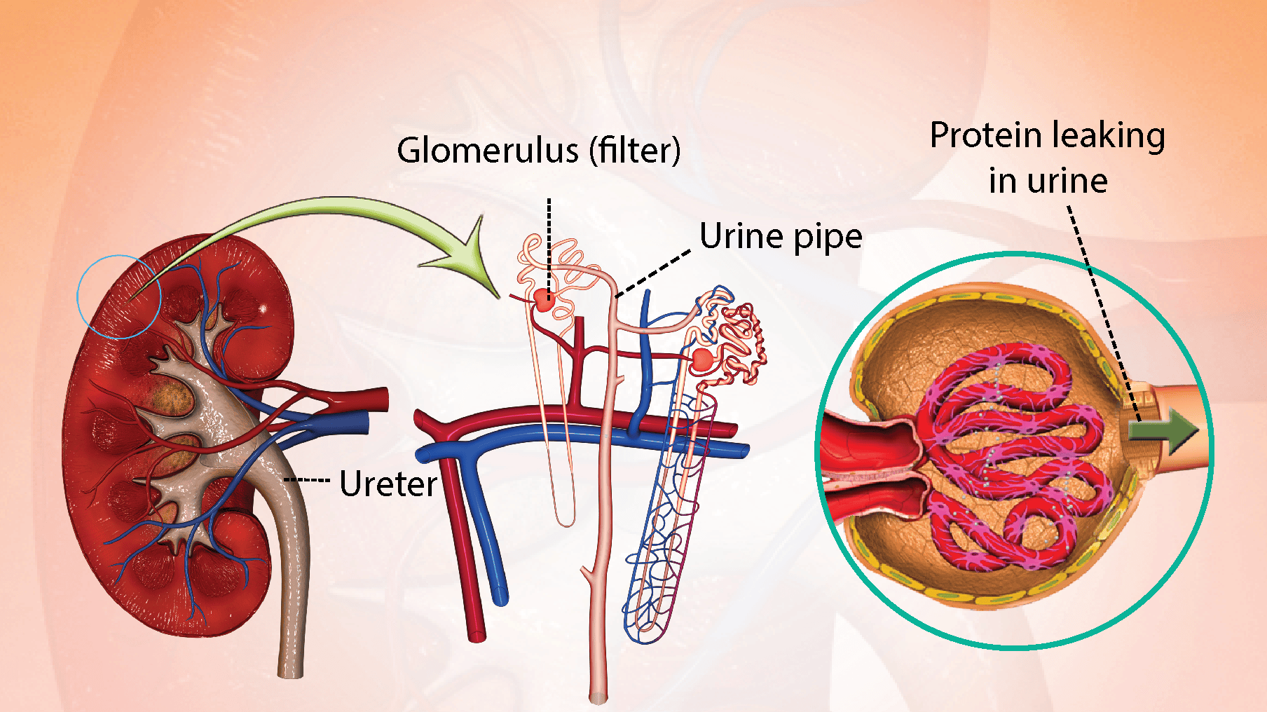 nephrotic-syndrome-diagnosis