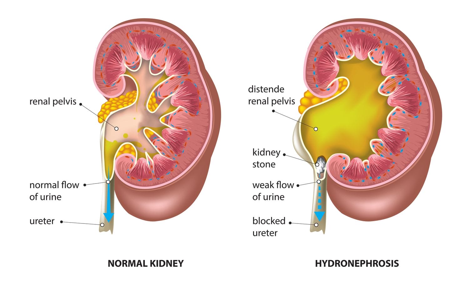 Blockage-of-urine-in-the-kidneys