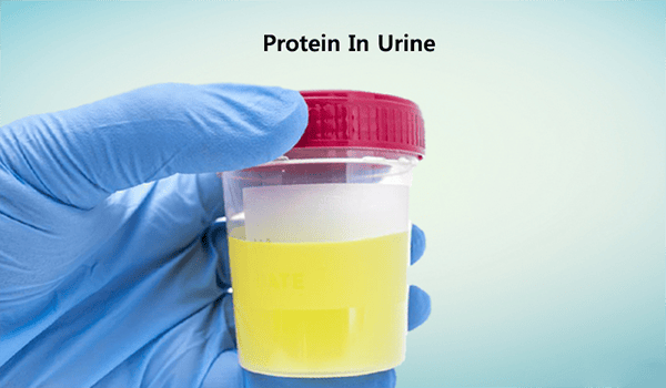 proteinuria-treatment